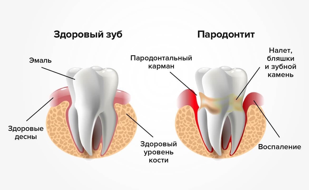 Пародонтит симптомы и лечение