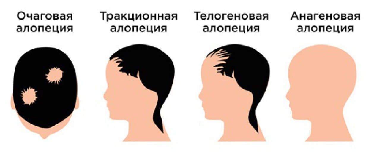 Алопеция у мужчин и женщин: причины, профилактика и эффективные методы восстановления