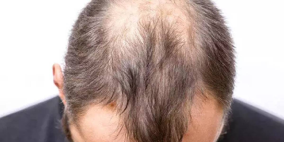 Алопеция у мужчин и женщин: причины, профилактика и эффективные методы восстановления
